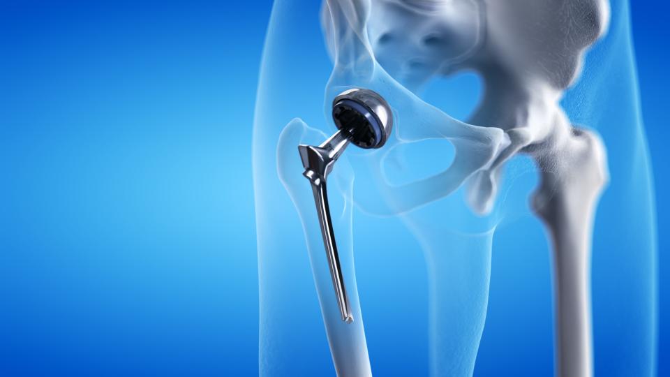 Hip Revision