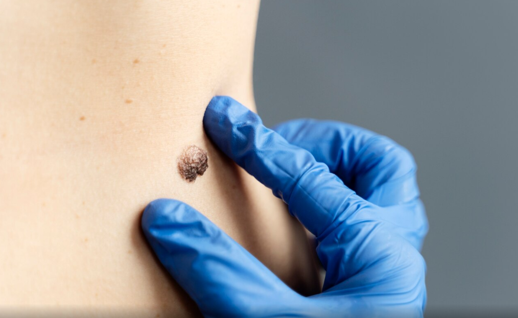 Skin Tag Removal Colchester