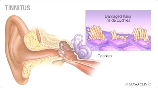 Tinnitus Treatment in Lahore