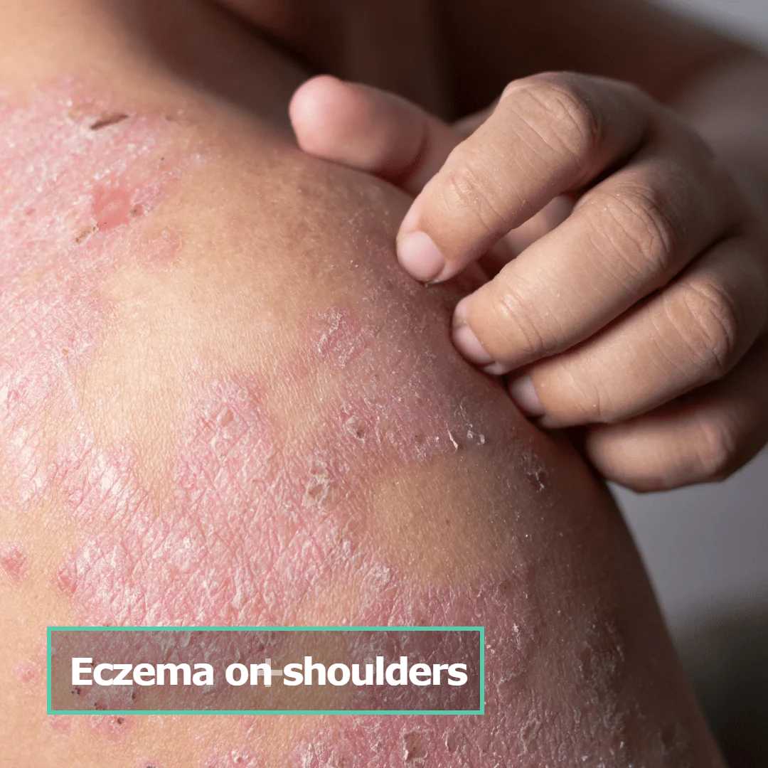 eczema on shoulders