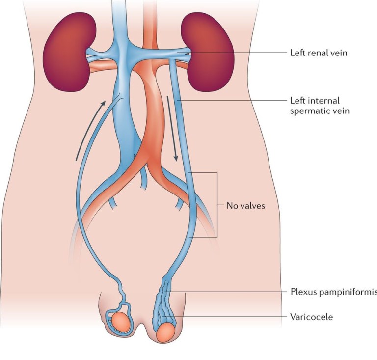 varicocele embolisation