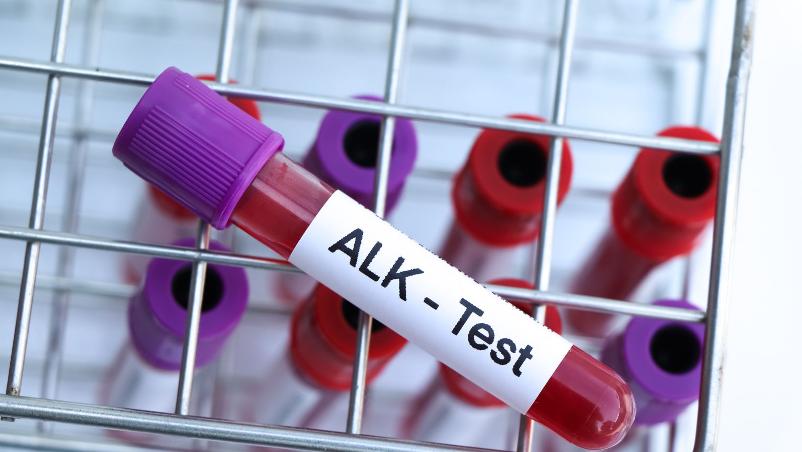 What does it mean if your alkaline phosphatase is high?