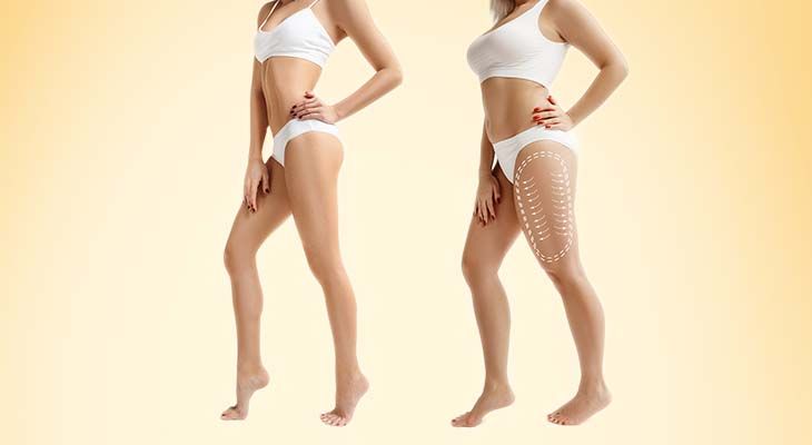 liposuction in Dubai