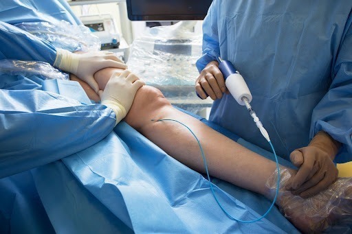 laser treatment for varicose veins