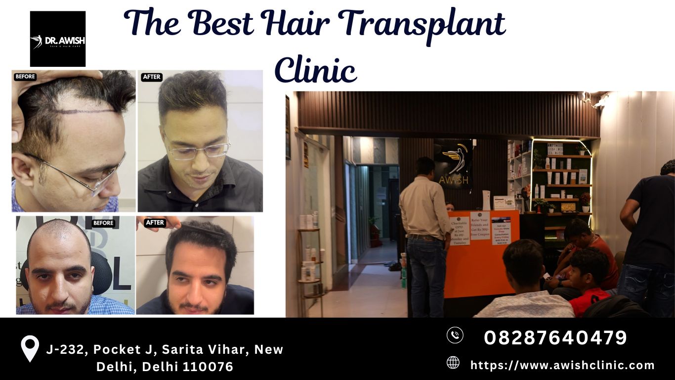 best hair clinic in Delhi